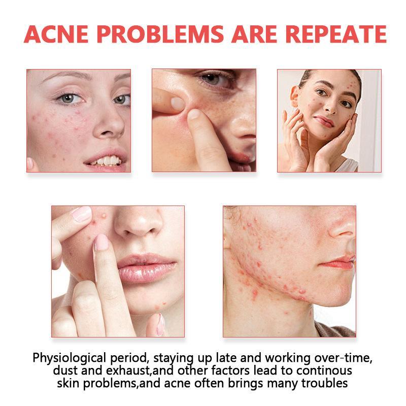 Acne Patches Invisible Hydroco - Skincare Oil Control 评论和价格